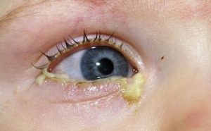 What Are Eye-Boogers and What Causes Them? baby eye booger 300x186 - What Are Eye-Boogers and What Causes Them?